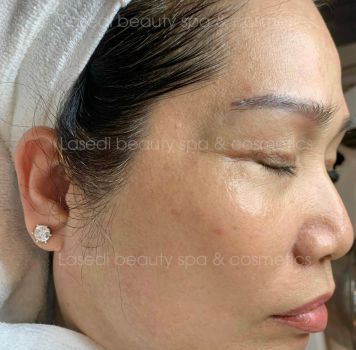 Điều trị da lão hóa, sạm, kém sắc tại Lasedi Beauty Spa Bảo Lộc