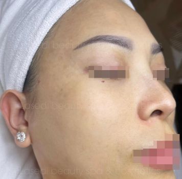 Điều trị nám chân đinh - sạm da tại Lasedi Beauty Spa Bảo Lộc