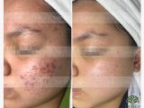 TRẢI NGHIỆM LẦN ĐẦU DỊCH VỤ ĐIỀU TRỊ MỤN CHỈ 199K